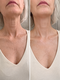 Neckline Renew