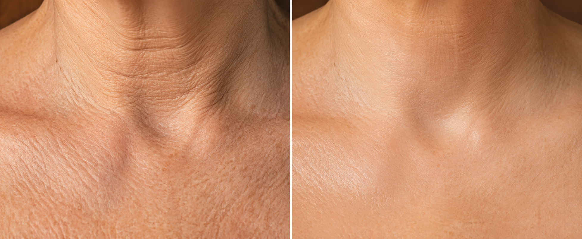 Illustration of skin texture — dry crepey texture compared with smoother, hydrated skin